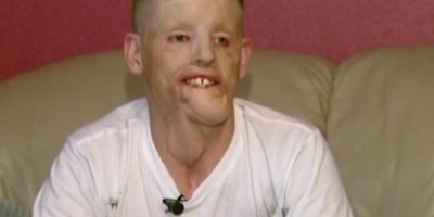 Người đàn ông ghép mặt kể câu chuyện cuộc đời sau 5 năm cấy ghép